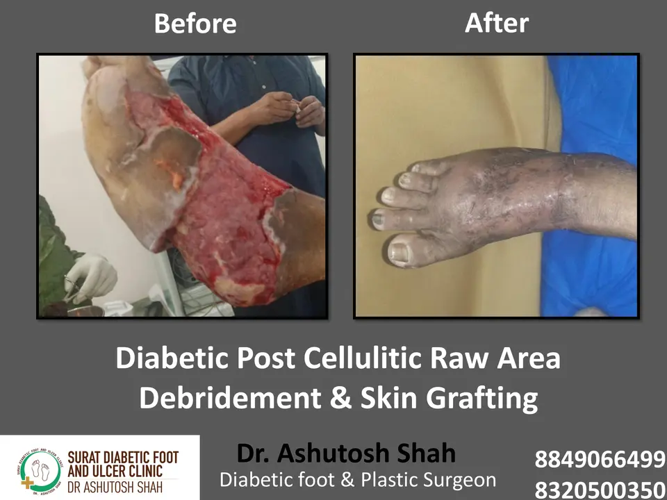 Diabetic Foot  PPT sunita.pptx-33.webp